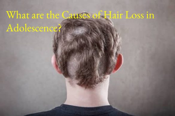 What are the Causes of Hair Loss in Adolescence_